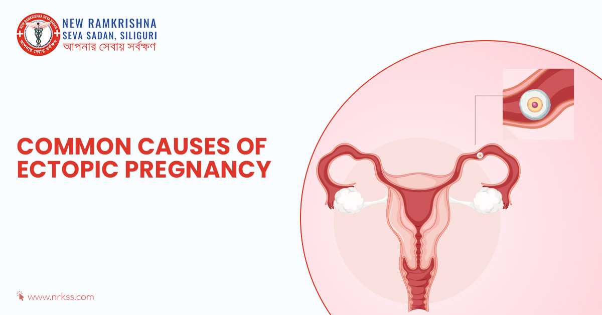 Common Causes of Ectopic Pregnancy