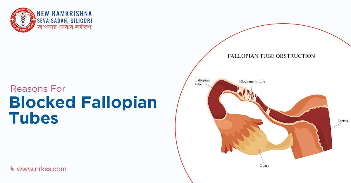 Your Gynecologist On What Leads To Fallopian Tube Blockage